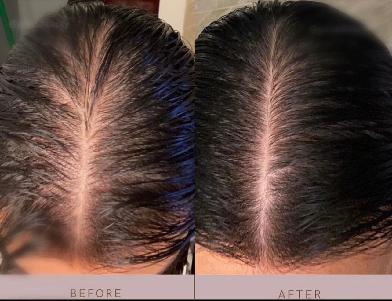 CrownElixer™ | Red Light Hair Therapy + Massager