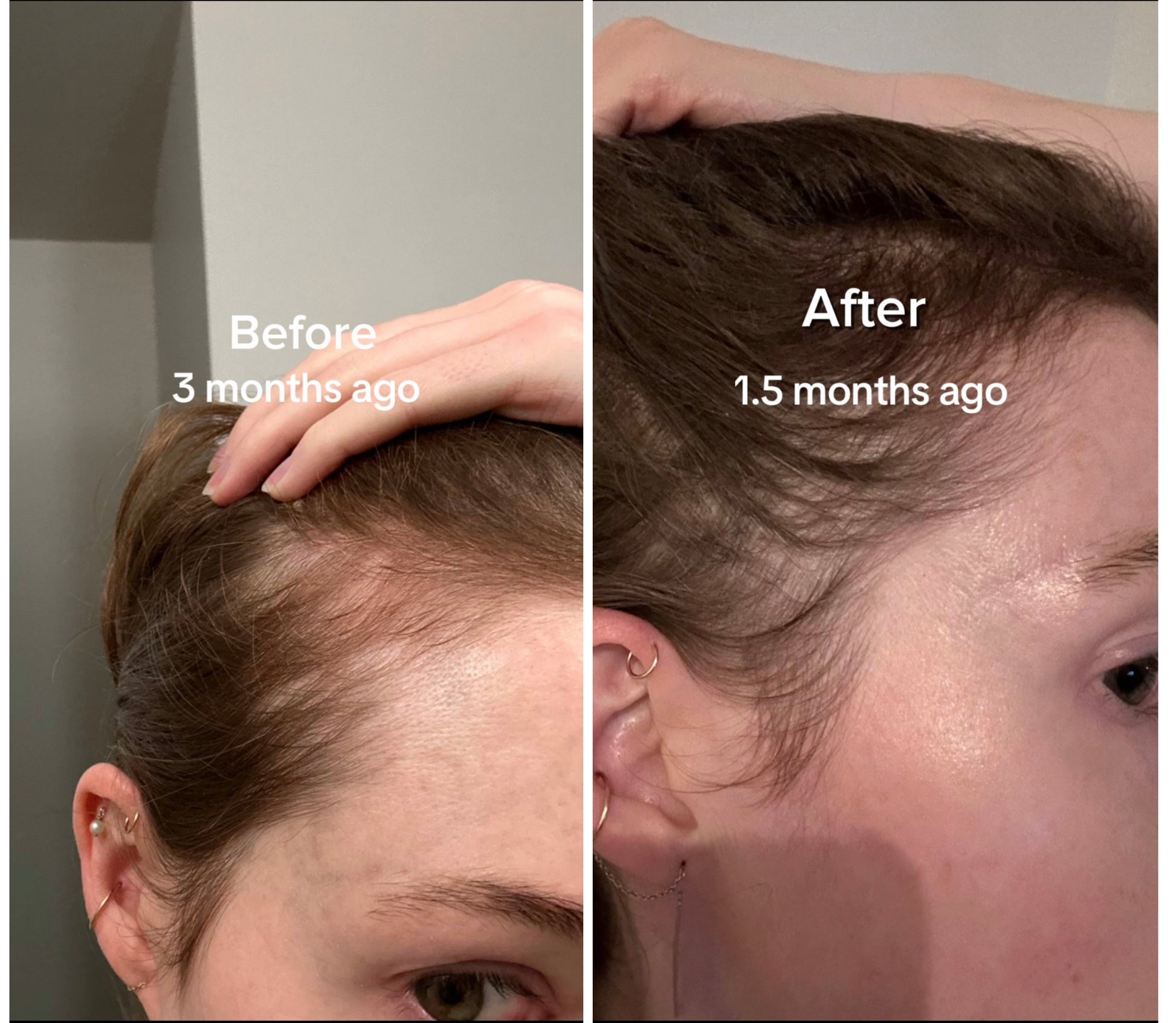 CrownElixer™ | Red Light Hair Therapy + Massager