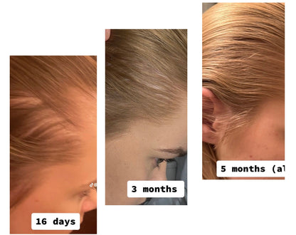 CrownElixer™ | Red Light Hair Therapy + Massager